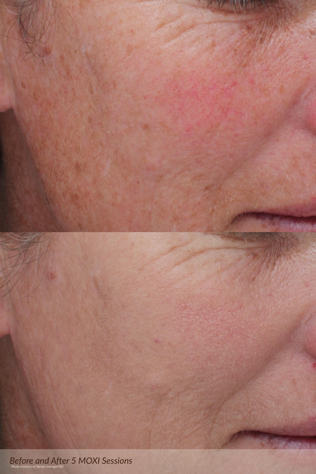 Before and after BBL treatment results
